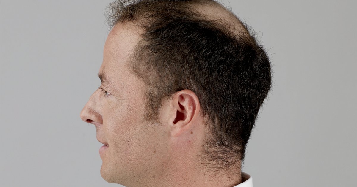 haarausfall ist kein schicksal mehr