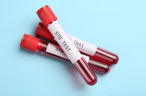 HIV- UND STI-TESTS