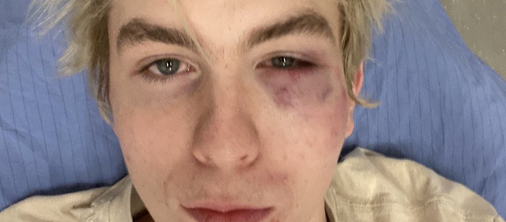 Kanadischer Student auf Party krankenhausreif geprügelt 